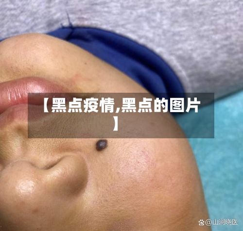 【黑点疫情,黑点的图片】-第1张图片